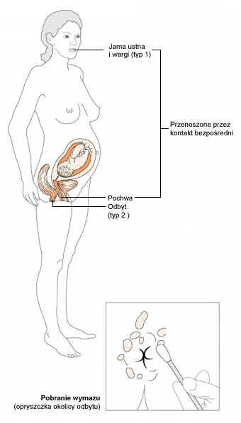 II typ- HSV-2 odpowiedzialny jest za opryszczkę narządów płciowych.